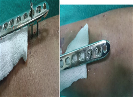 “Freeing” of head of locking screw, creating difficulty in implant removal.