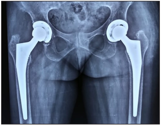 Post-operative X-ray of Single B/L THR; B/L THR: Bilateral Total Hip Replacement (B/L THR).