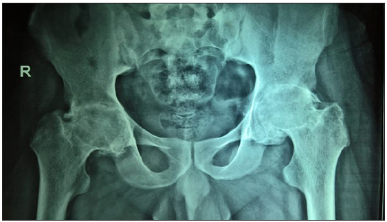 Pre-operative X-ray (R-right side) of Staged B/L THR; B/L THR: Bilateral Total Hip Replacement.