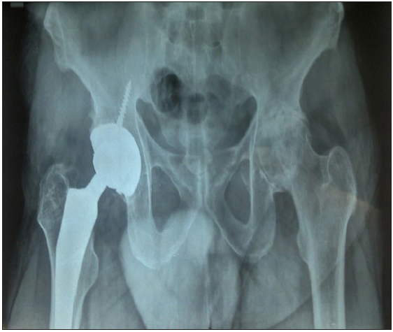 Post-operative X-ray of Staged B/L THR operated on one side; B/L THR: Bilateral Total Hip Replacement.