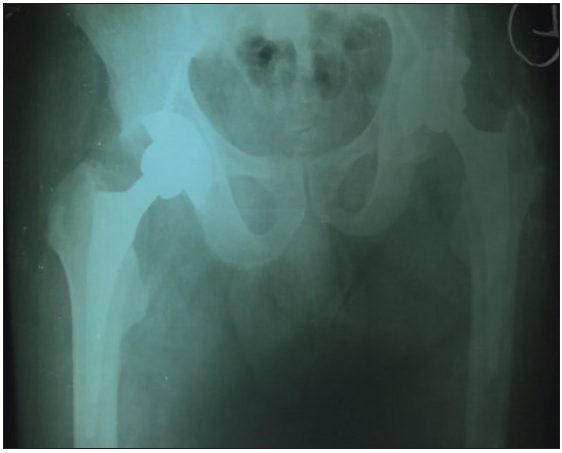 Post-operative X-ray of Staged B/L THR operated on other side; B/L THR: Bilateral Total Hip Replacement (B/L THR).