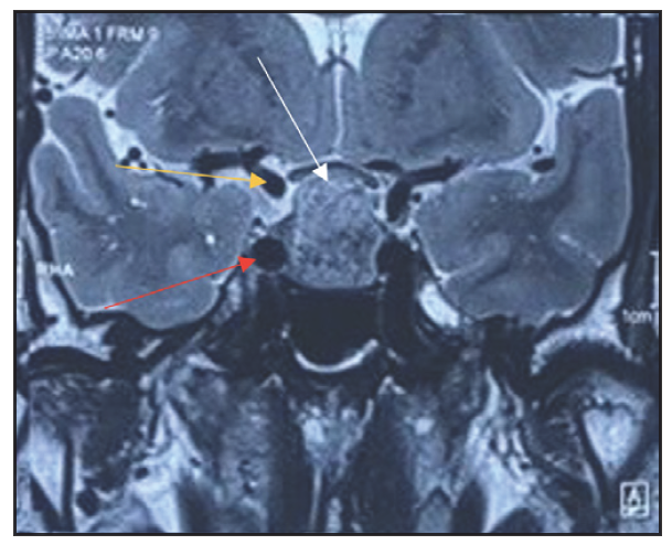 Coronal T2 WI MRI image (preop) showing sellar mass with no para-sellar extension (white arrow), Right Cavernous segment of ICA (Red arrow), Right Supraclinoid segment of ICA (Yellow arrow) (Original)