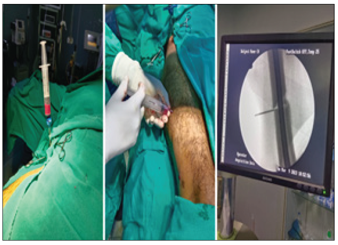 Aspirating BM with a Jamshidi needle and injecting it into the fracture site.