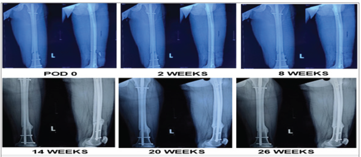 Case 1. Radiological union in fractured lower shaft of the femur.