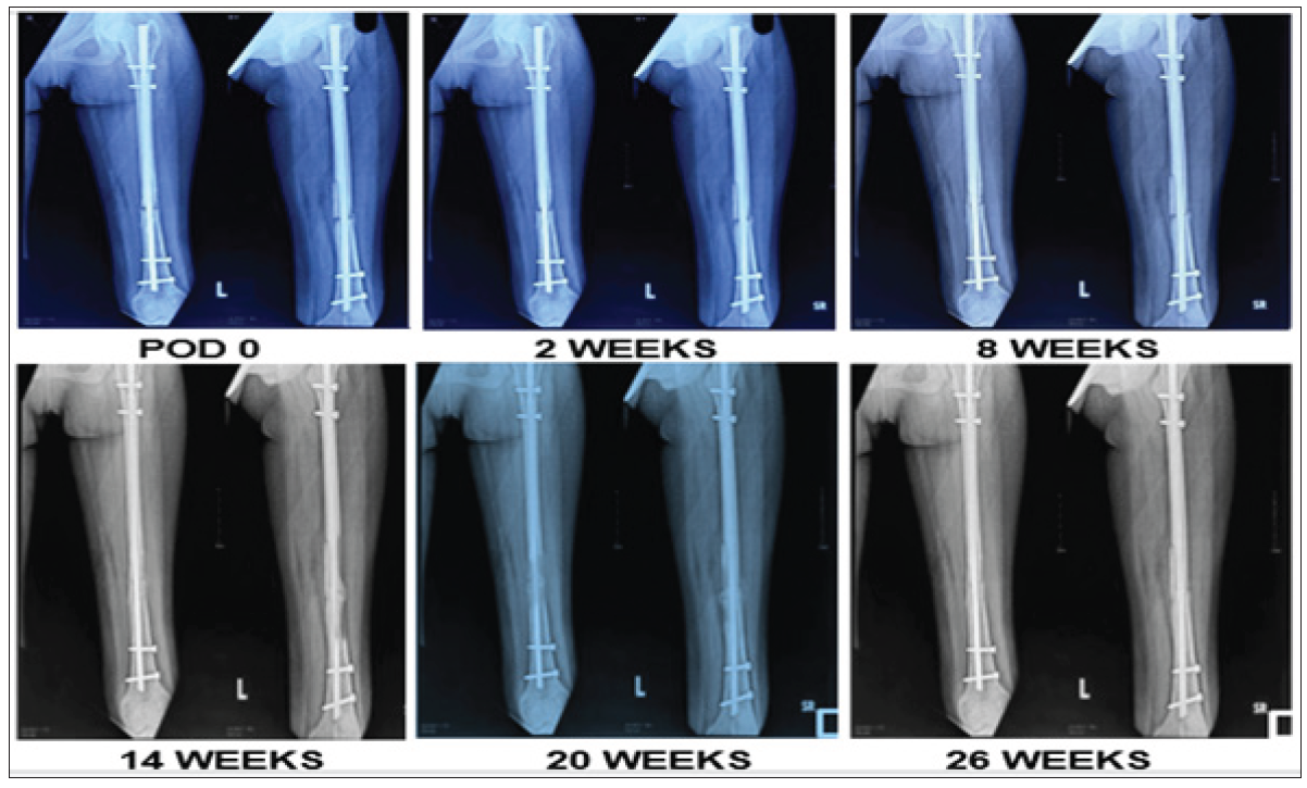 Case 2. Radiological union in comminuted fracture shaft femur.