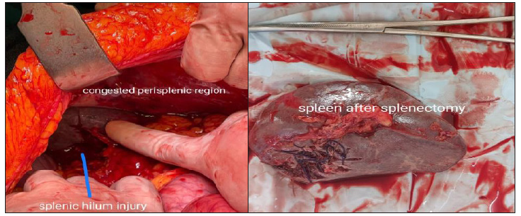 (a) Splenic rupture at hilum. (b) Spleen after splenectomy.