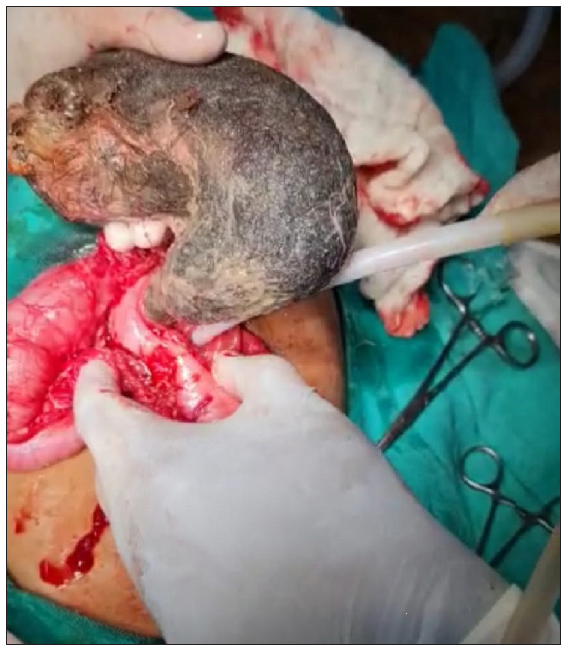 Removal of trichobezoar through gastrotomy.