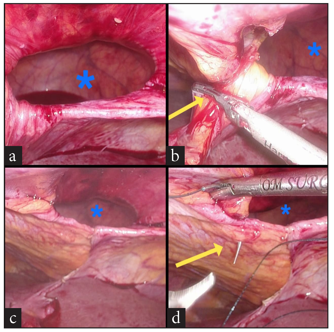 (a) Diaphragmatic hernial defect (blue asterisk) after complete reduction of contents, (b) Diaphragmatic hernial defect (blue asterisk), division of falciform ligament (yellow arrow) to make way for the mesh, (c) Diaphragmatic hernial defect (blue asterisk), post division of the falciform ligament, (d) Diaphragmatic hernial defect (blue asterisk), suture closure of defect (yellow arrow) initiated.