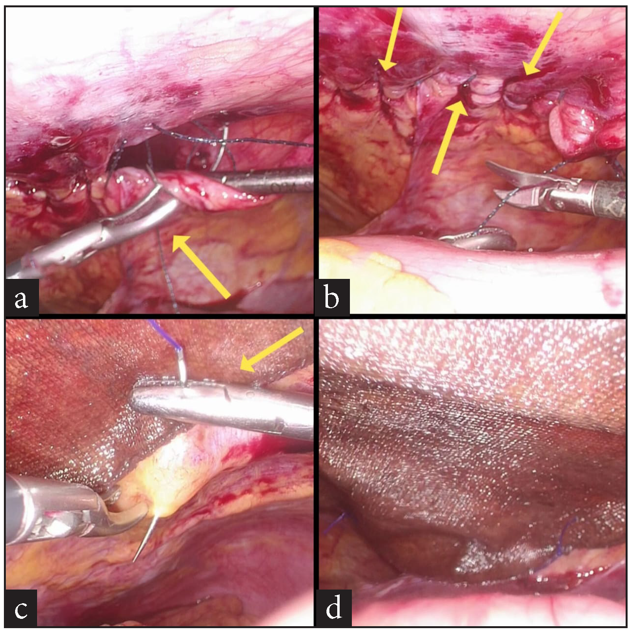 (a) Suture closure of hernial defect in progress (yellow arrow), (b) the completed suture line (yellow arrows), (c) suture fixation of composite mesh to diaphragm (yellow arrow) over the suture line, (d) the end result.