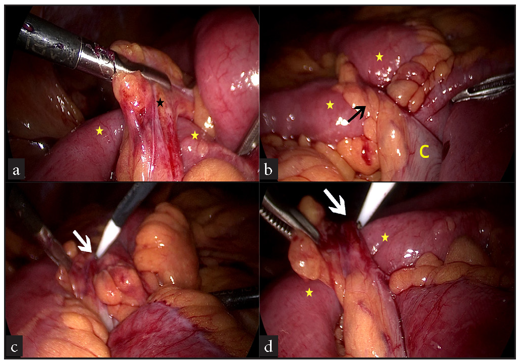 (a) Culprit obstructing tourniquet (black asterisk) being lifted off the small bowel (yellow asterisks), (b) Epiploical tourniquet (black arrow) attached to sigmoid colon (yellow ‘C’) bridging over and compressing terminal ileum (yellow asterisks), (c,d) Hook with monopolar cautery (white arrows) being used to divide the tourniquet over the ileum (yellow asterisks).