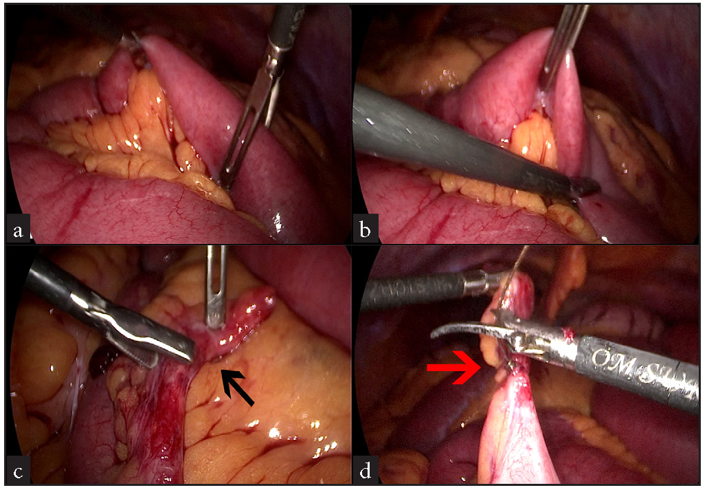 (a,b) Small bowel ‘walk’ being performed to rule out any other sites of obstruction, (c) Inflamed & elongated tourniquet (black arrow) after division, (d) Ligation of it’s base (red arrow) with Endoloop.