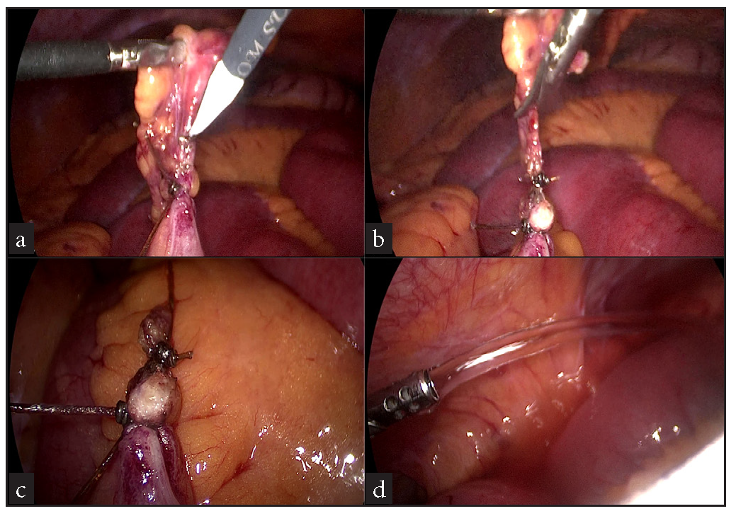 (a, b) Base of culprit appendix epiploica being transected, (c) Endresult, (d) Local peritoneal toilet being given.